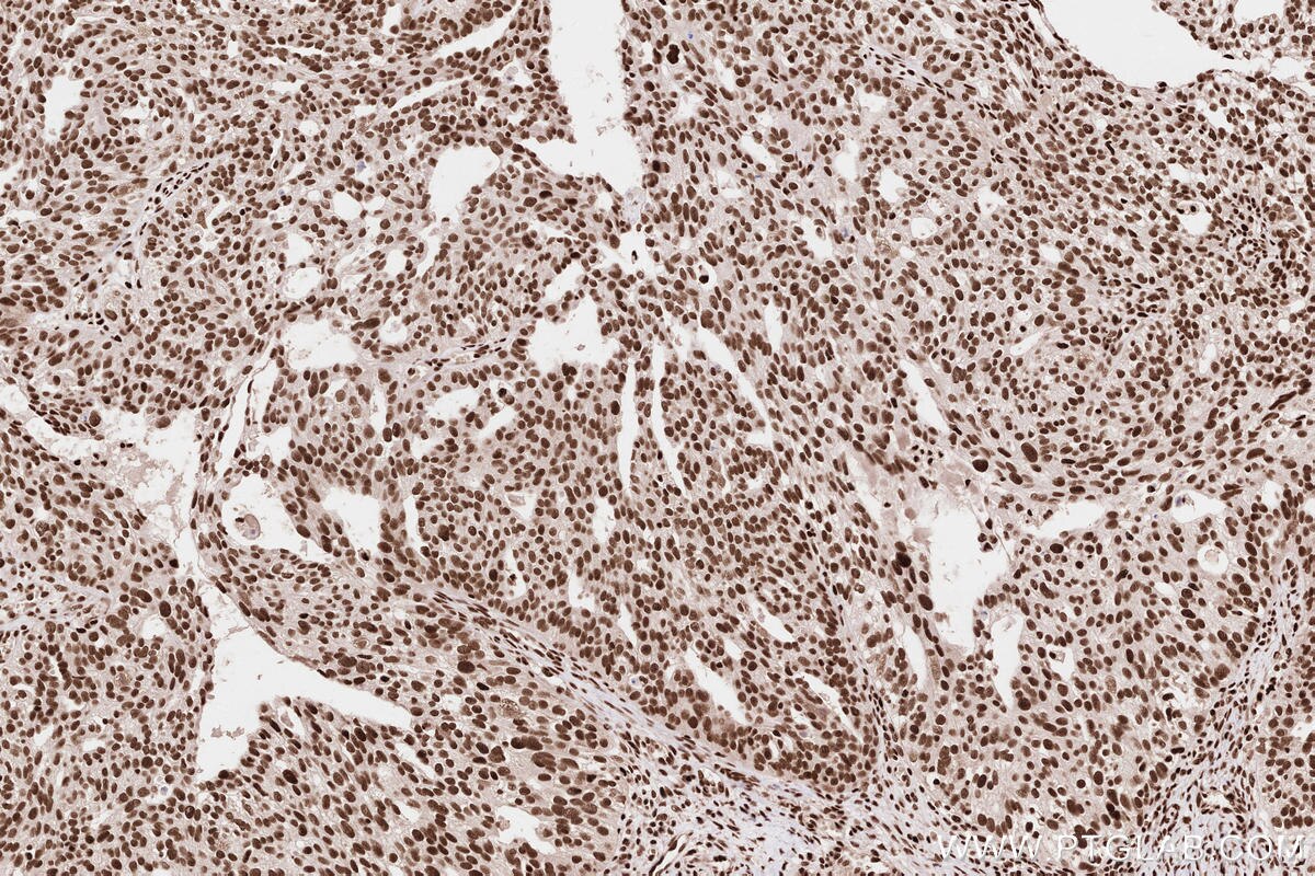 Immunohistochemical analysis of paraffin-embedded human ovary cancer tissue slide using KHC2584 (ZCCHC8 IHC Kit).