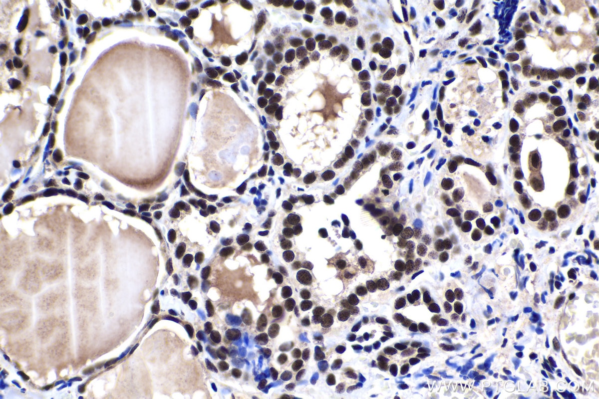 Immunohistochemical analysis of paraffin-embedded human thyroid cancer tissue slide using KHC1457 (ZFP161 IHC Kit).