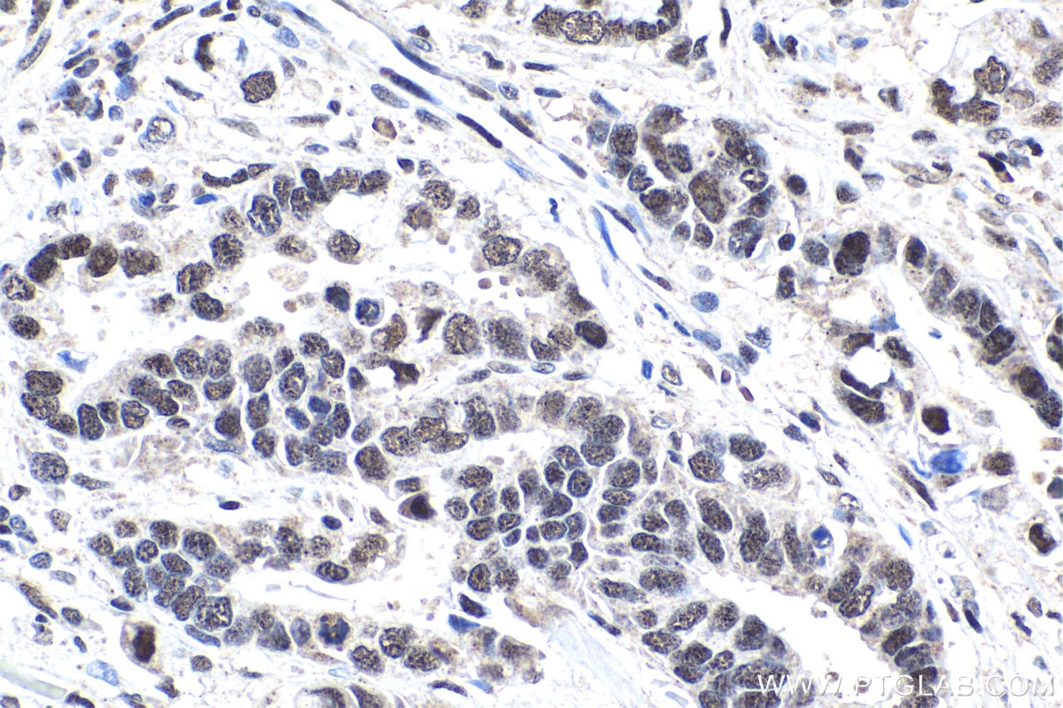 Immunohistochemical analysis of paraffin-embedded human stomach cancer tissue slide using KHC1819 (ZFPM1 IHC Kit).