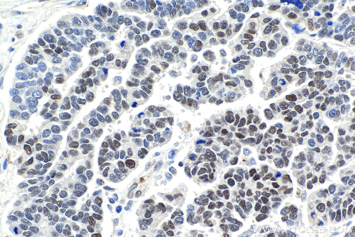 Immunohistochemical analysis of paraffin-embedded human ovary tumor tissue slide using KHC2034 (ZHX2 IHC Kit).
