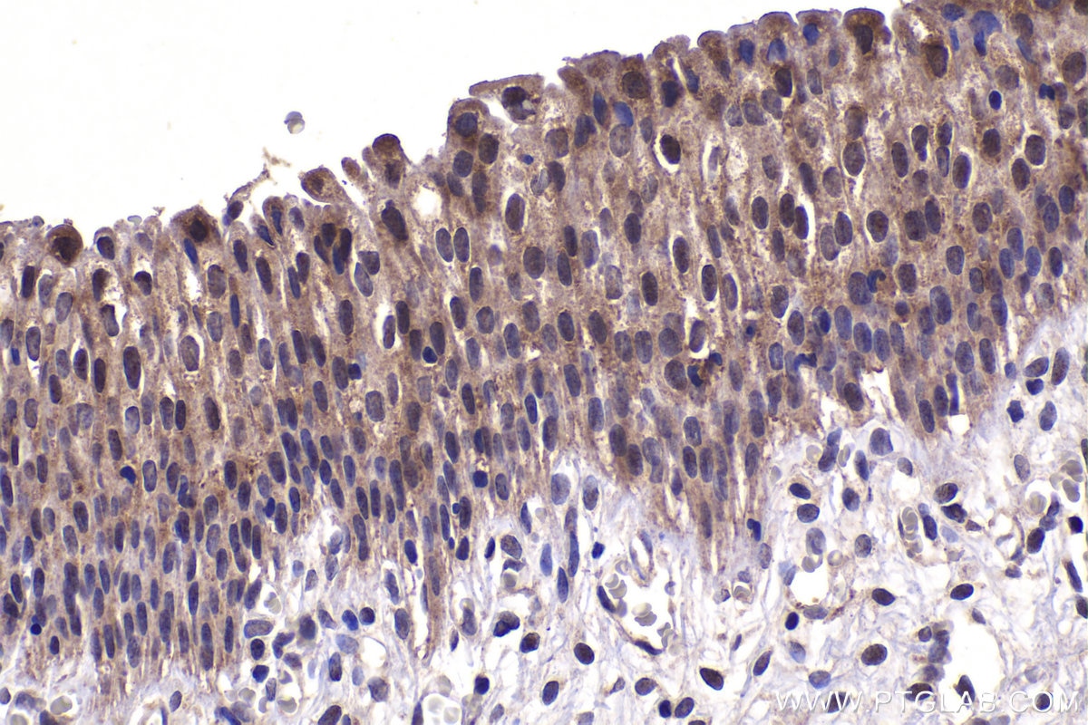Immunohistochemical analysis of paraffin-embedded human urothelial carcinoma tissue slide using KHC1467 (ZIC3 IHC Kit).