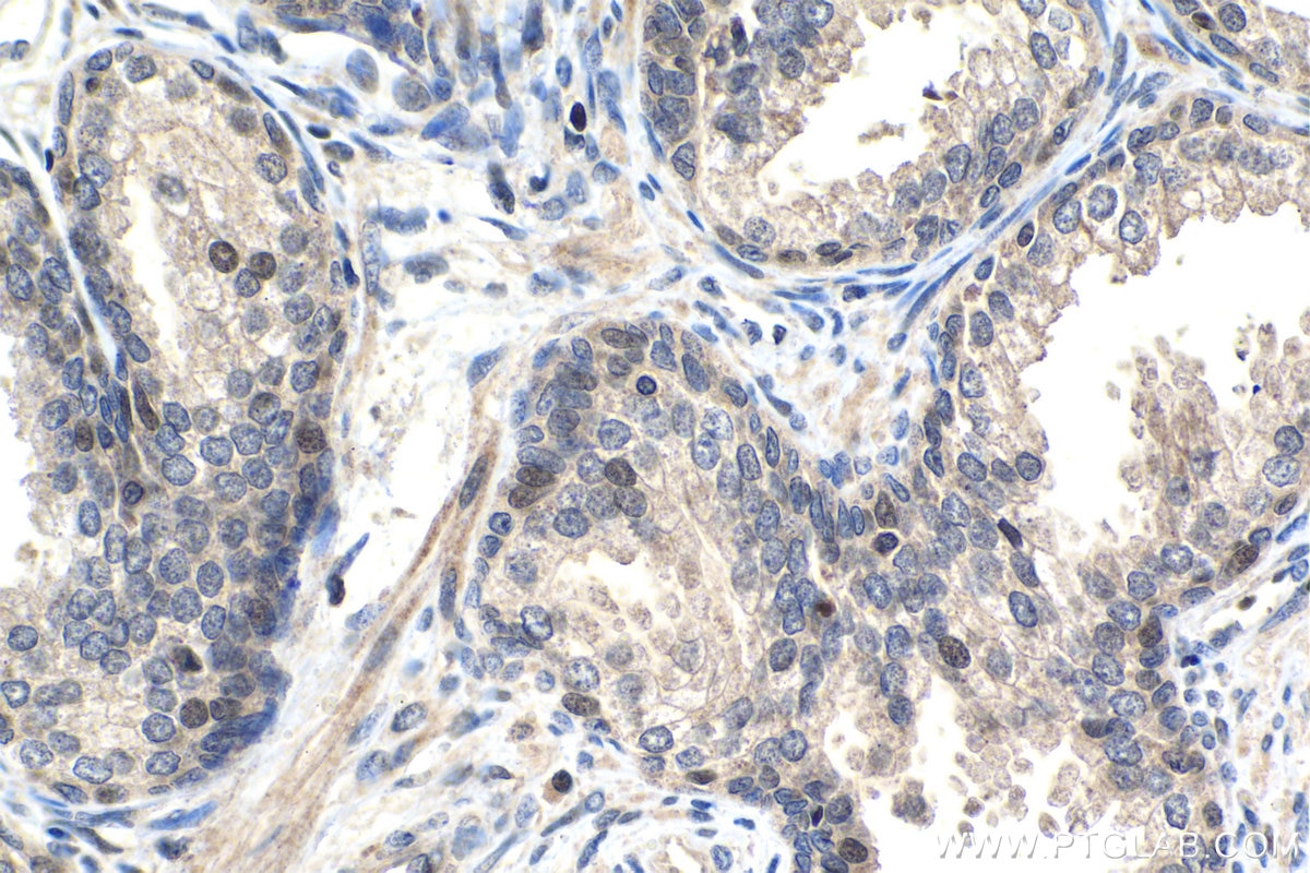 Immunohistochemical analysis of paraffin-embedded human prostate cancer tissue slide using KHC1478 (ZMPSTE24 IHC Kit).