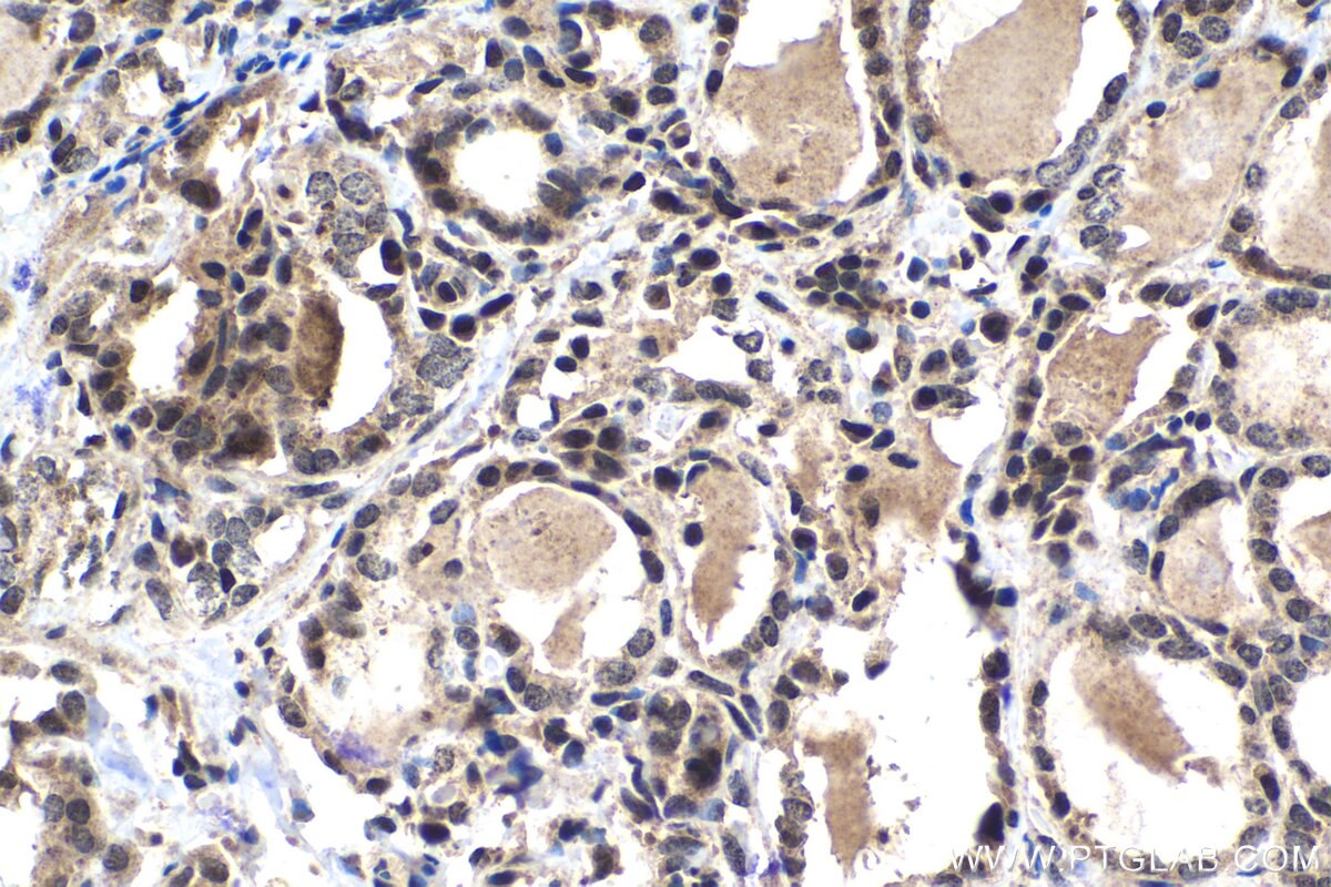 Immunohistochemical analysis of paraffin-embedded human thyroid cancer tissue slide using KHC1478 (ZMPSTE24 IHC Kit).