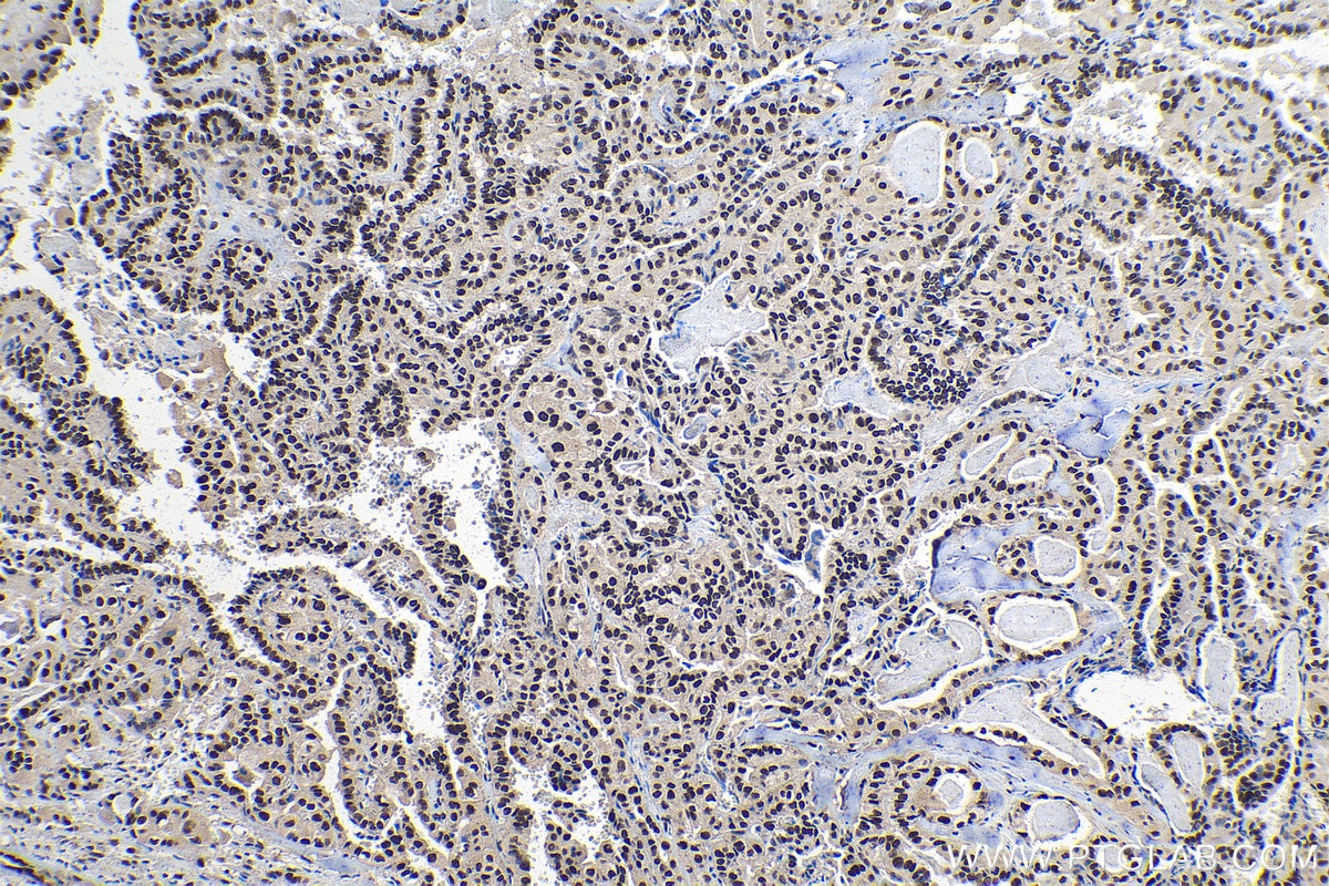 Immunohistochemical analysis of paraffin-embedded human thyroid cancer tissue slide using KHC1399 (ZMYM3 IHC Kit).
