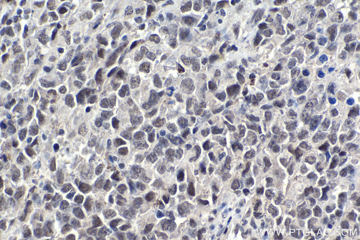 Immunohistochemical analysis of paraffin-embedded human malignant melanoma tissue slide using KHC1826 (ZNF101 IHC Kit).
