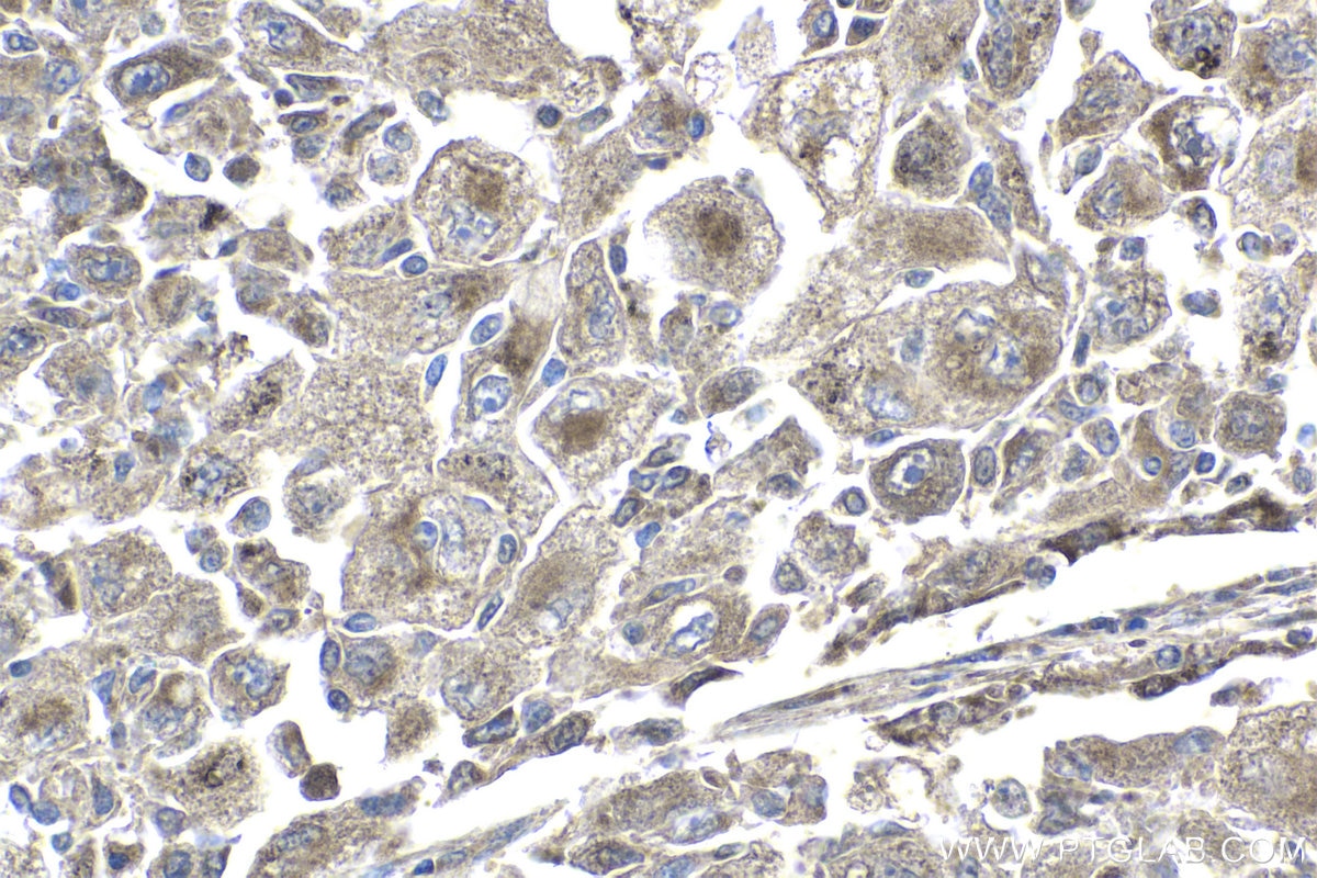 Immunohistochemical analysis of paraffin-embedded human lung cancer tissue slide using KHC1838 (ZNF397 IHC Kit).