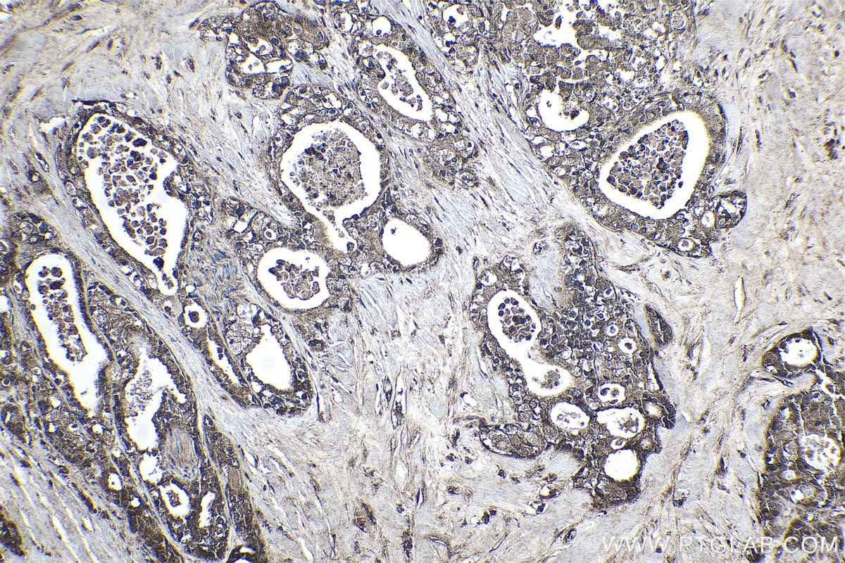 Immunohistochemical analysis of paraffin-embedded human pancreas cancer tissue slide using KHC1838 (ZNF397 IHC Kit).