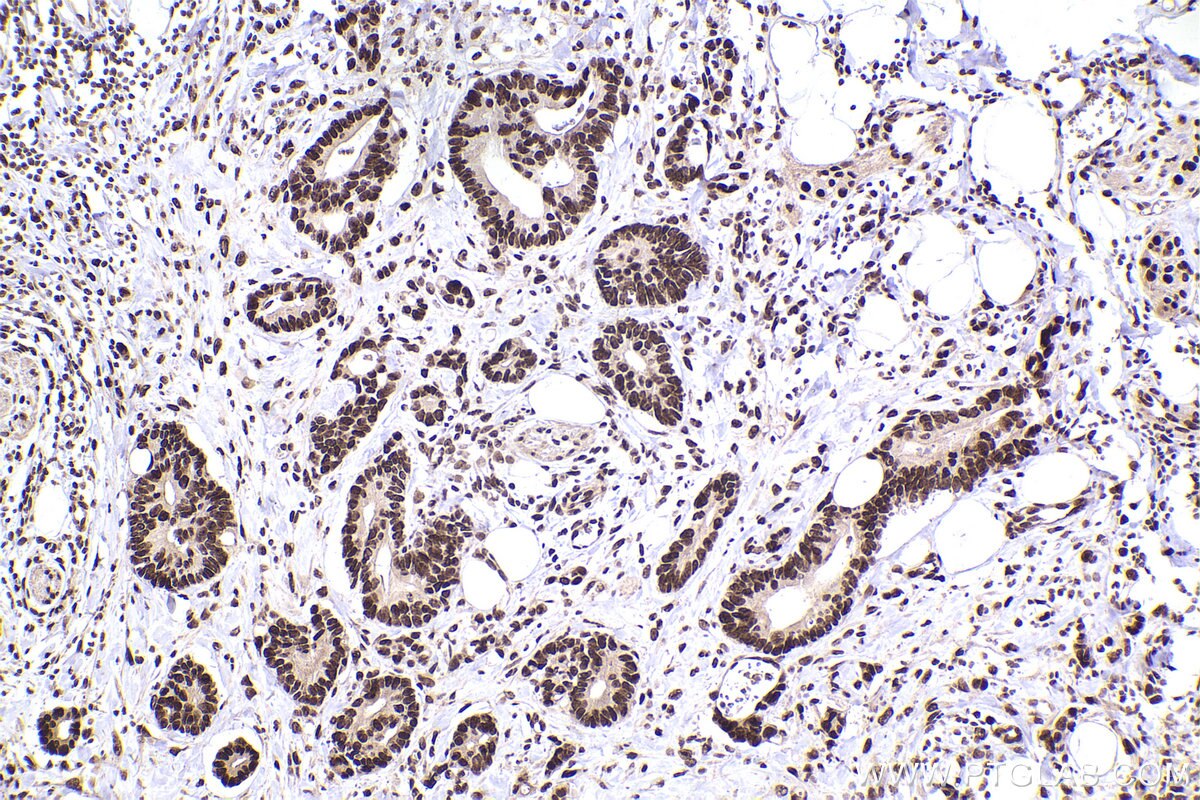 Immunohistochemical analysis of paraffin-embedded human rectal cancer tissue slide using KHC2470 (ZNF638 IHC Kit).