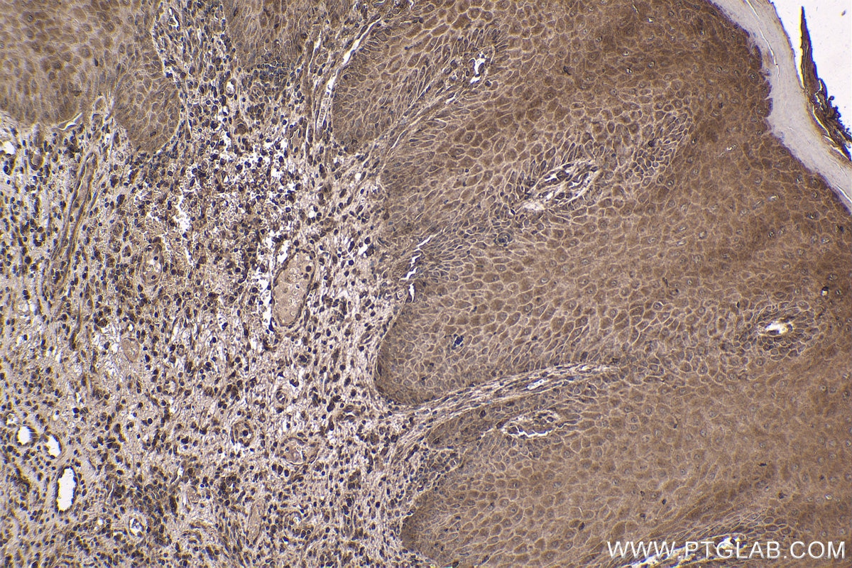 Immunohistochemical analysis of paraffin-embedded human skin cancer tissue slide using KHC1787 (ZNF746 IHC Kit).