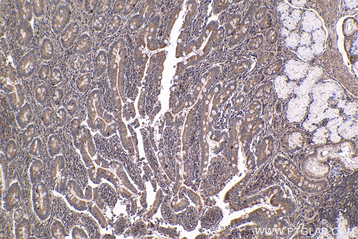 Immunohistochemical analysis of paraffin-embedded human stomach cancer tissue slide using KHC1787 (ZNF746 IHC Kit).