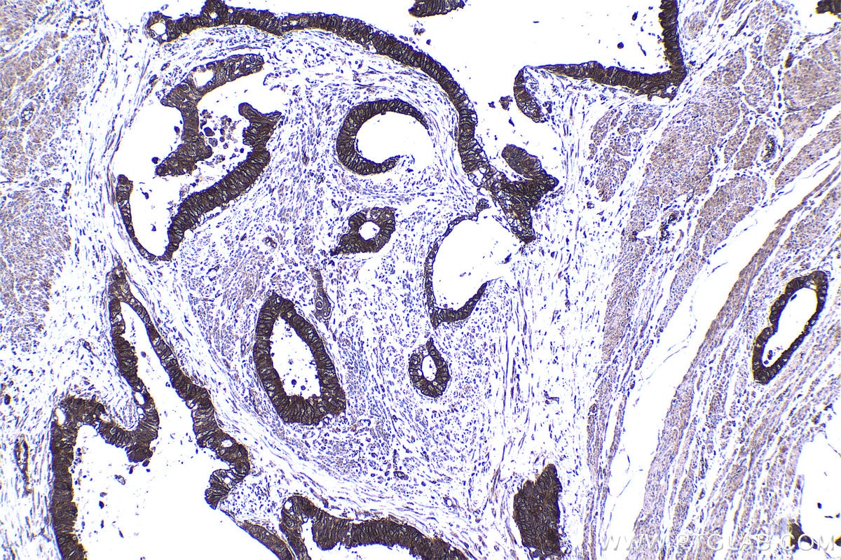 Immunohistochemical analysis of paraffin-embedded human urothelial carcinoma tissue slide using KHC1472 (ZPR1 IHC Kit).