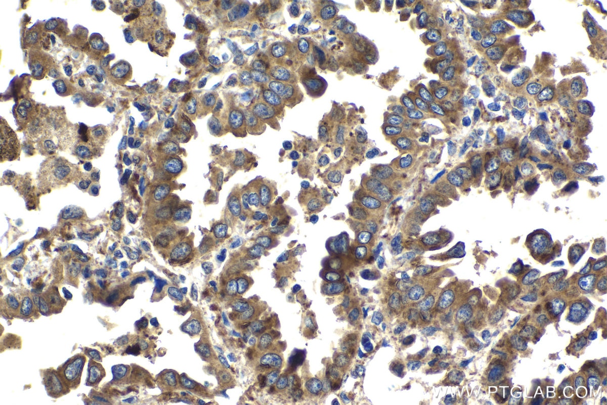 Immunohistochemical analysis of paraffin-embedded human lung cancer tissue slide using KHC2078 (ZW10 IHC Kit).