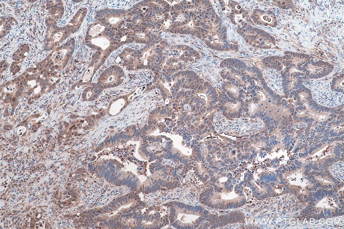 Immunohistochemical analysis of paraffin-embedded human colon cancer tissue slide using KHC0871 (ZYX IHC Kit).