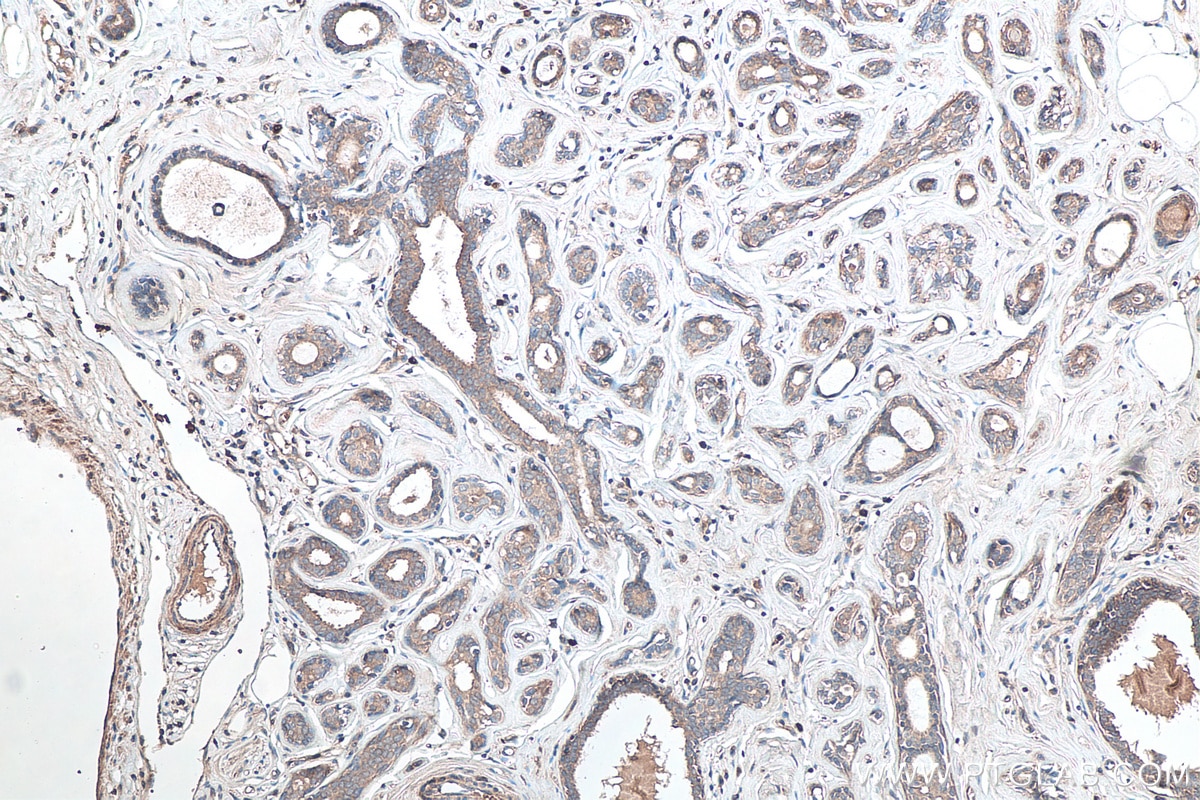Immunohistochemical analysis of paraffin-embedded human breast cancer tissue slide using KHC0117 (c-SRC IHC Kit).