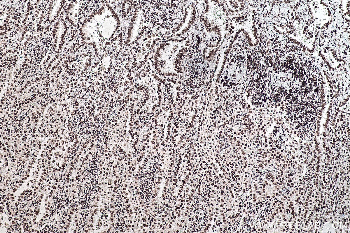 Immunohistochemical analysis of paraffin-embedded human lung cancer tissue slide using KHC0143 (m6A IHC Kit).
