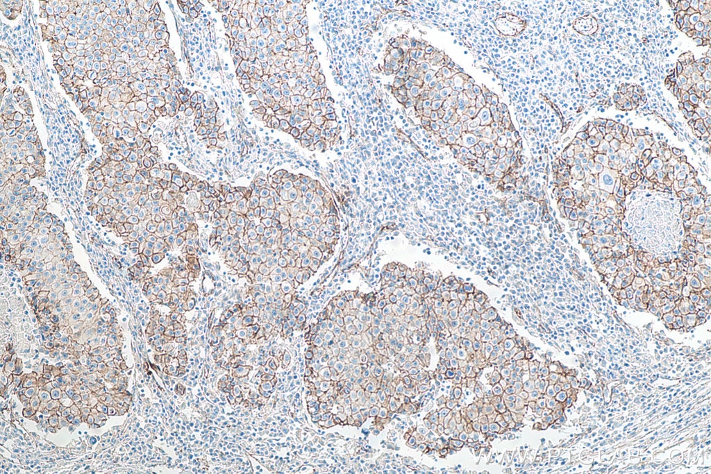 Immunohistochemical analysis of paraffin-embedded human breast cancer tissue slide using KHC0009 (p120 Catenin IHC Kit).