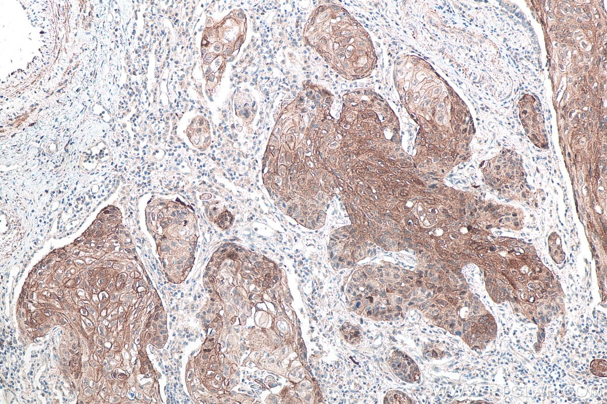 Immunohistochemical analysis of paraffin-embedded human lung cancer tissue slide using KHC0118 (p38 MAPK IHC Kit).