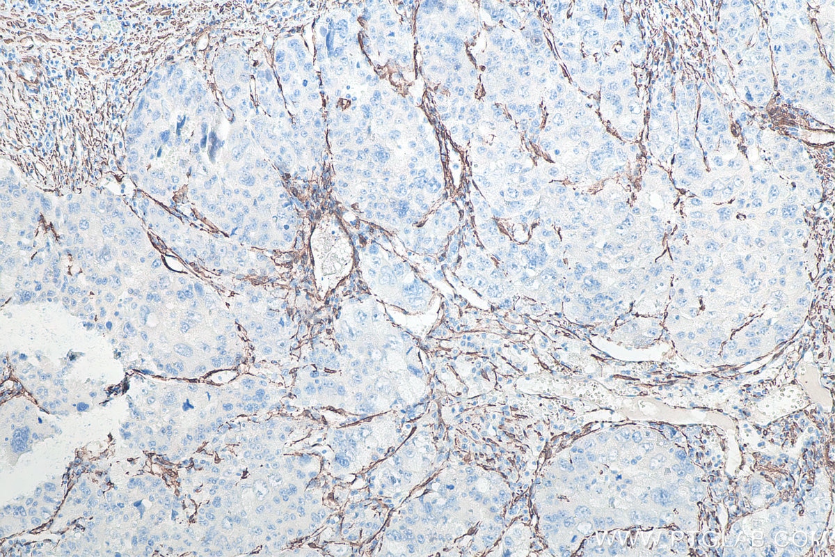 Immunohistochemical analysis of paraffin-embedded human liver cancer tissue slide using KHC0053 (smooth muscle actin specific IHC Kit).