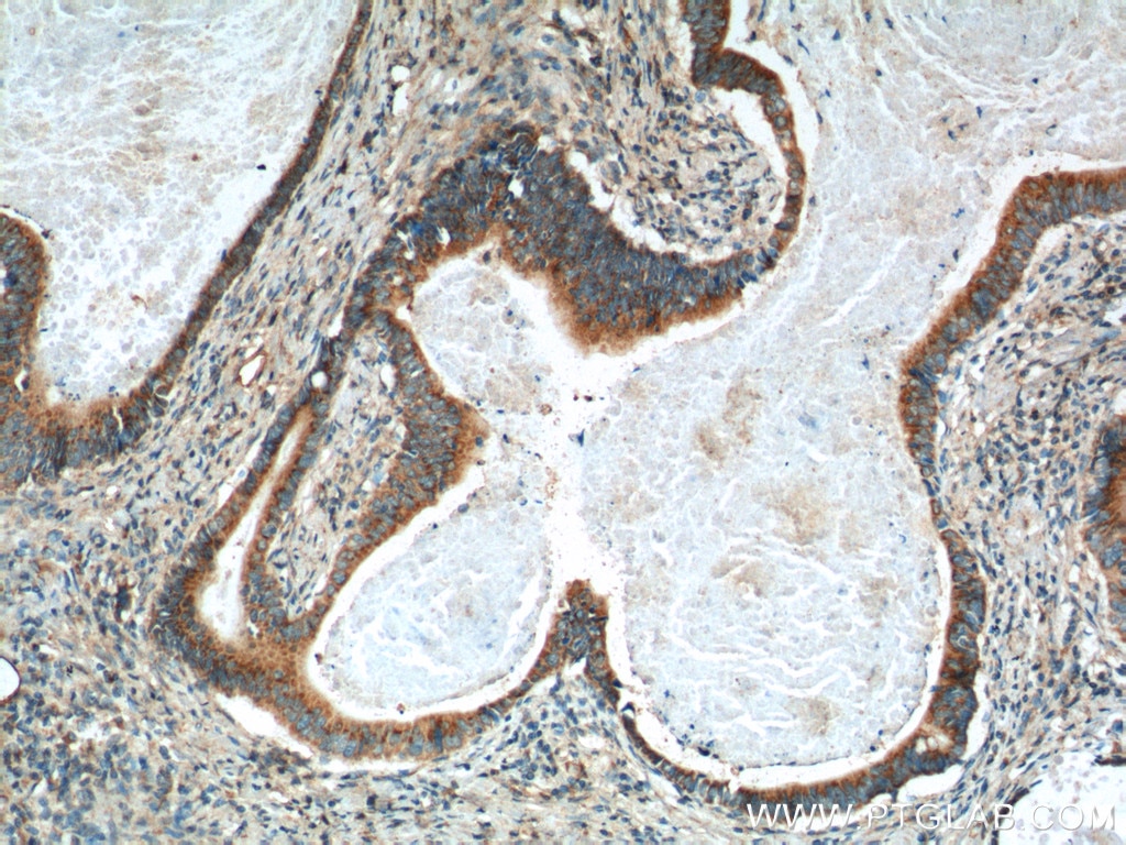 Immunohistochemistry (IHC) staining of human stomach cancer tissue using IHH Polyclonal antibody (13388-1-AP)