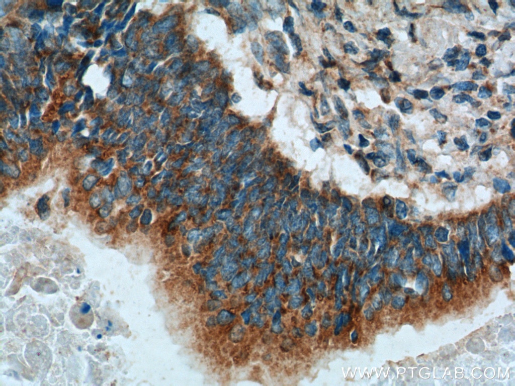 Immunohistochemistry (IHC) staining of human stomach cancer tissue using IHH Polyclonal antibody (13388-1-AP)