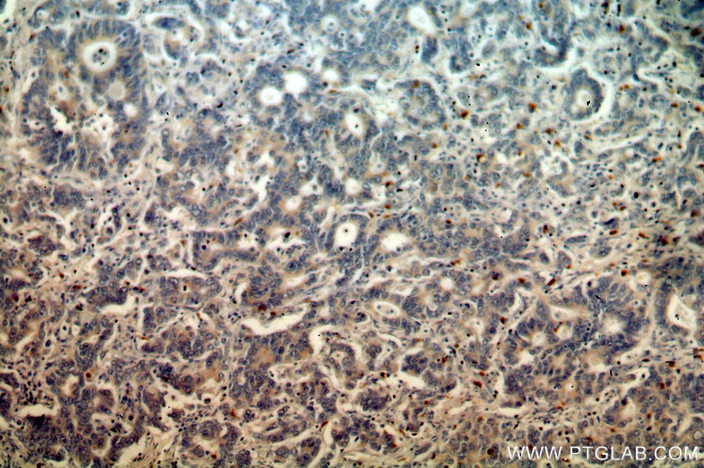 Immunohistochemistry (IHC) staining of human stomach cancer tissue using IHH Polyclonal antibody (13388-1-AP)