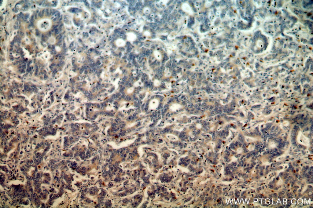 IHC staining of human stomach cancer using 13388-1-AP