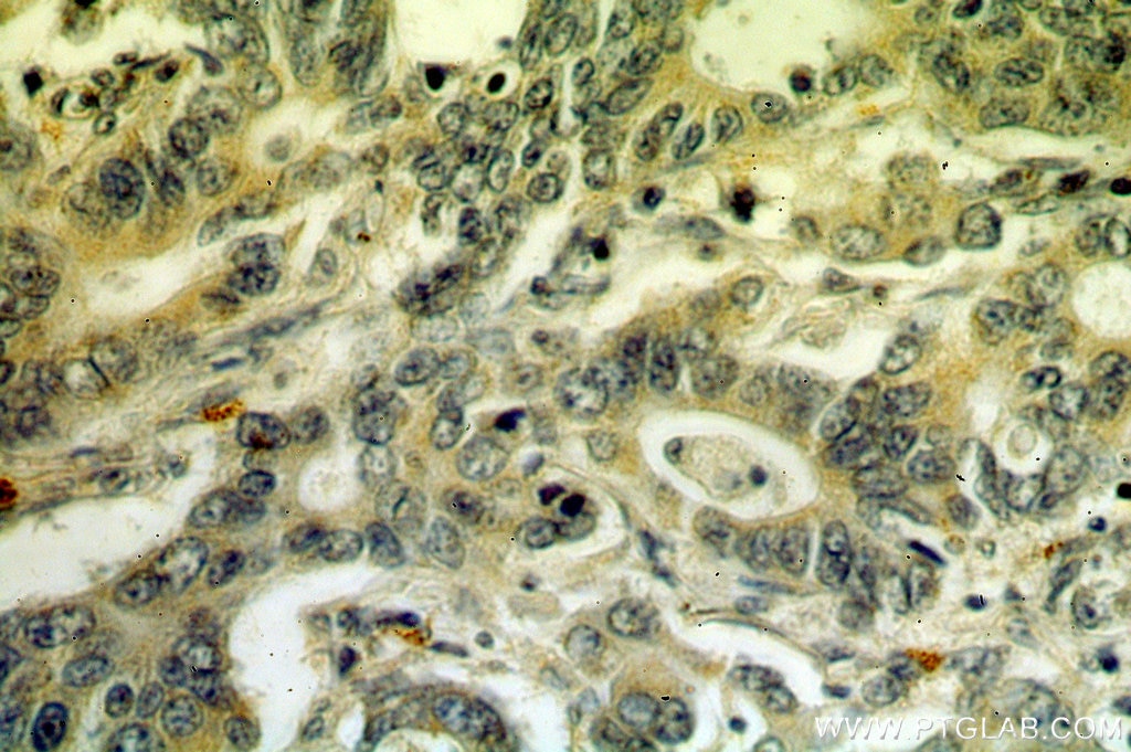 Immunohistochemistry (IHC) staining of human stomach cancer tissue using IHH Polyclonal antibody (13388-1-AP)