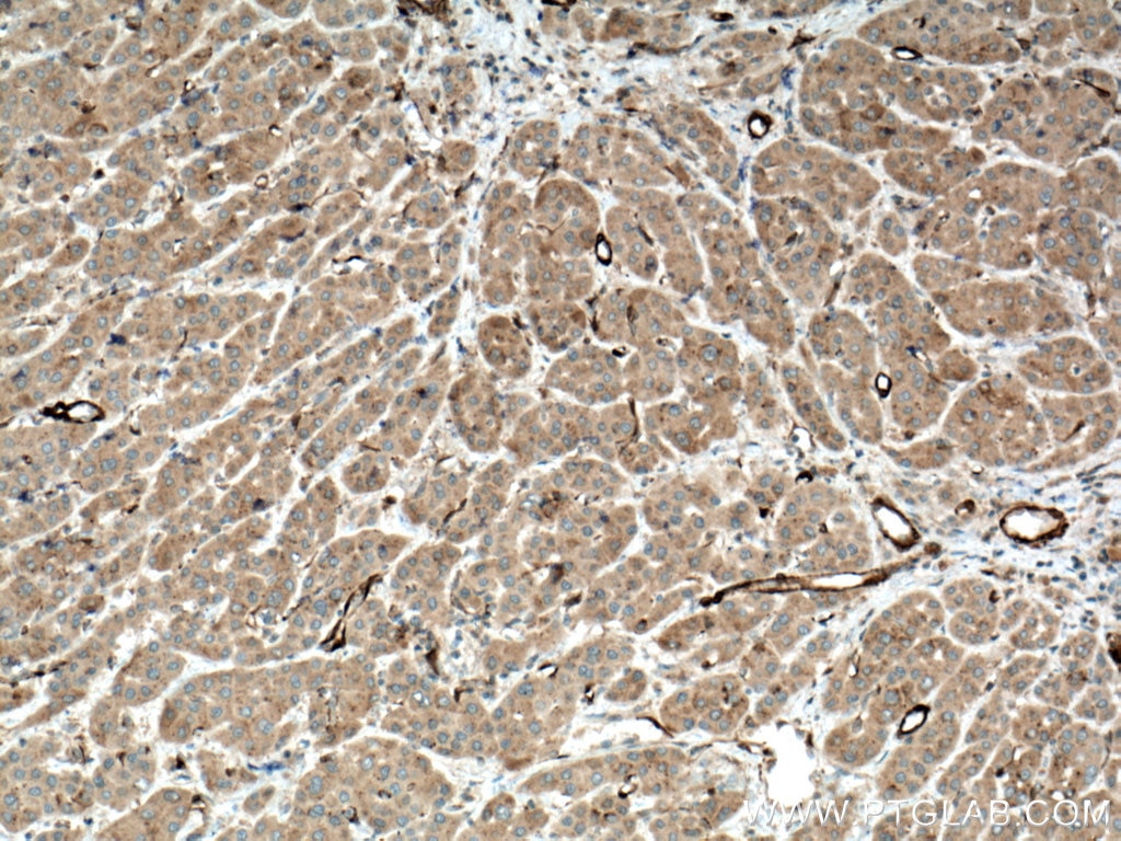 Immunohistochemistry (IHC) staining of human liver cancer tissue using IKBKB Polyclonal antibody (15649-1-AP)