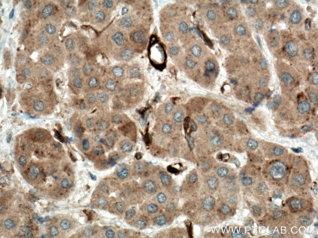 Immunohistochemistry (IHC) staining of human liver cancer tissue using IKBKB Polyclonal antibody (15649-1-AP)