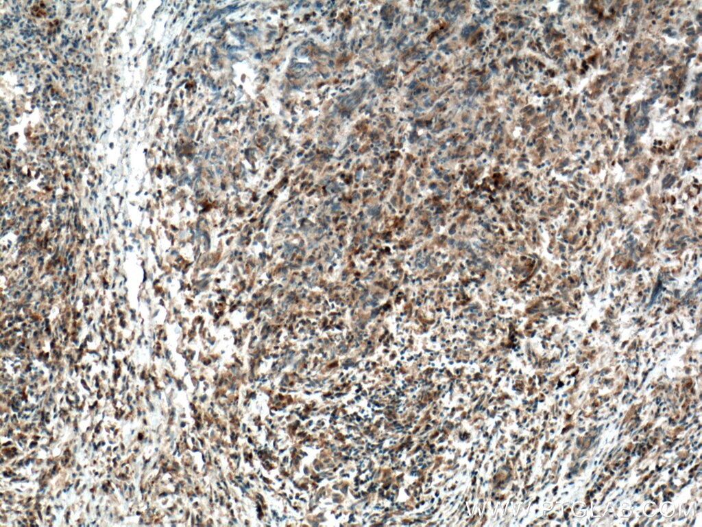 Immunohistochemistry (IHC) staining of human prostate cancer tissue using IKBKB Polyclonal antibody (15649-1-AP)