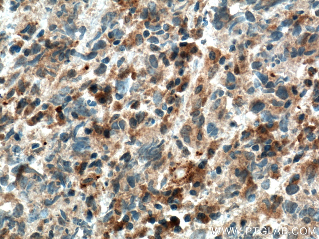 Immunohistochemistry (IHC) staining of human prostate cancer tissue using IKBKB Polyclonal antibody (15649-1-AP)