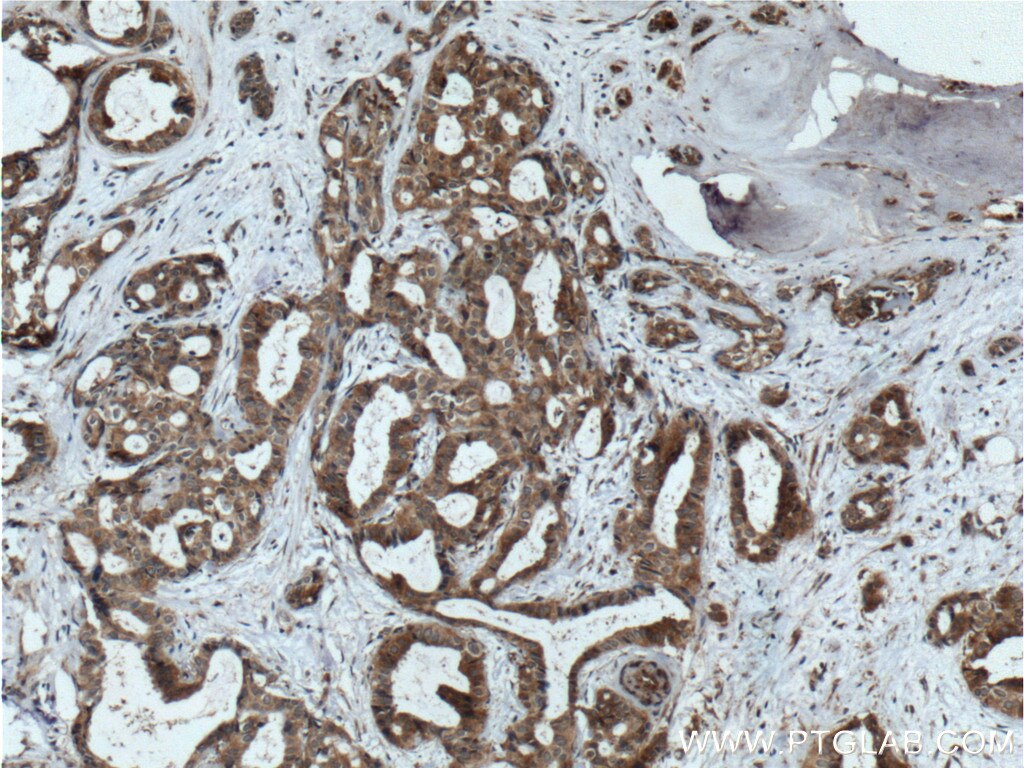 Immunohistochemistry (IHC) staining of human breast cancer tissue using IKBKB Polyclonal antibody (20979-1-AP)