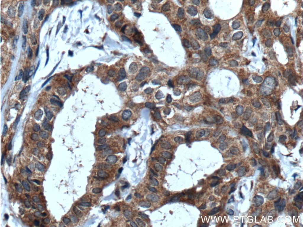 Immunohistochemistry (IHC) staining of human breast cancer tissue using IKBKB Polyclonal antibody (20979-1-AP)