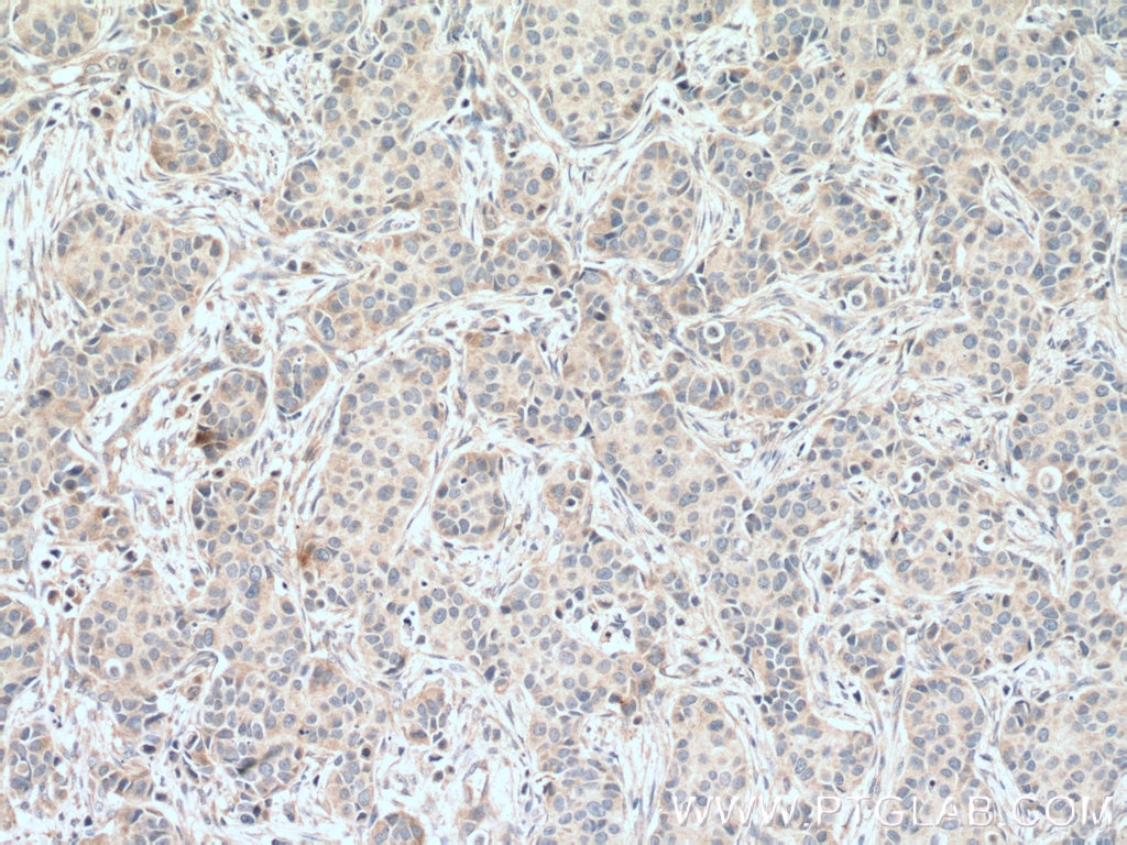 Immunohistochemistry (IHC) staining of human breast cancer tissue using IKBKG Monoclonal antibody (66460-1-Ig)