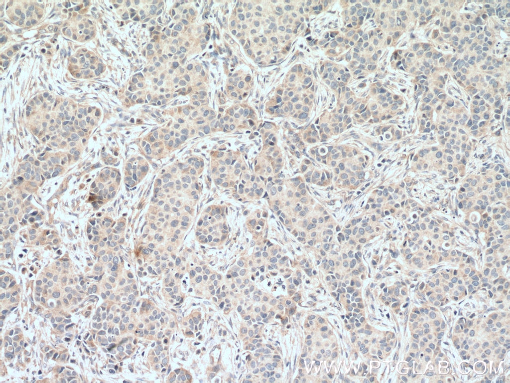 IHC staining of human breast cancer using 66460-1-Ig