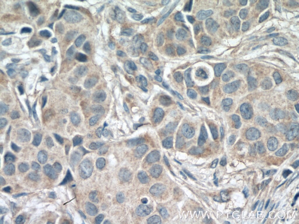 Immunohistochemistry (IHC) staining of human breast cancer tissue using IKBKG Monoclonal antibody (66460-1-Ig)