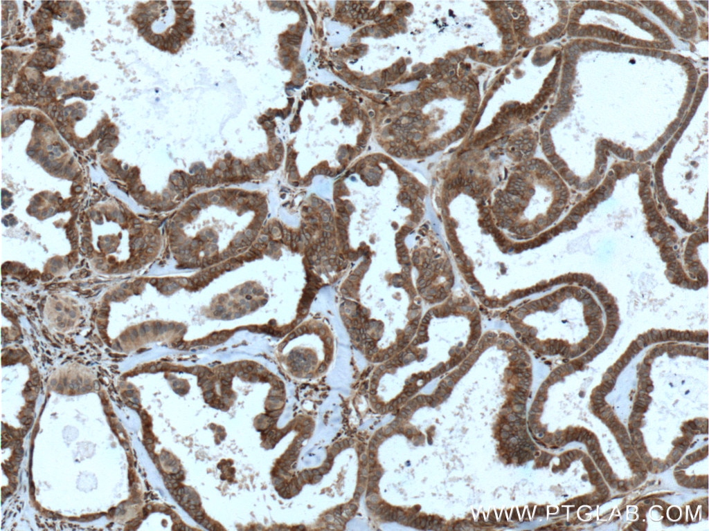 Immunohistochemistry (IHC) staining of human ovary tumor tissue using IKIP Polyclonal antibody (14589-1-AP)