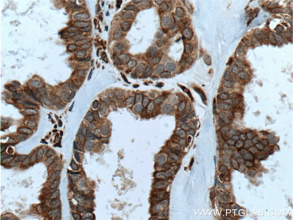 Immunohistochemistry (IHC) staining of human ovary tumor tissue using IKIP Polyclonal antibody (14589-1-AP)