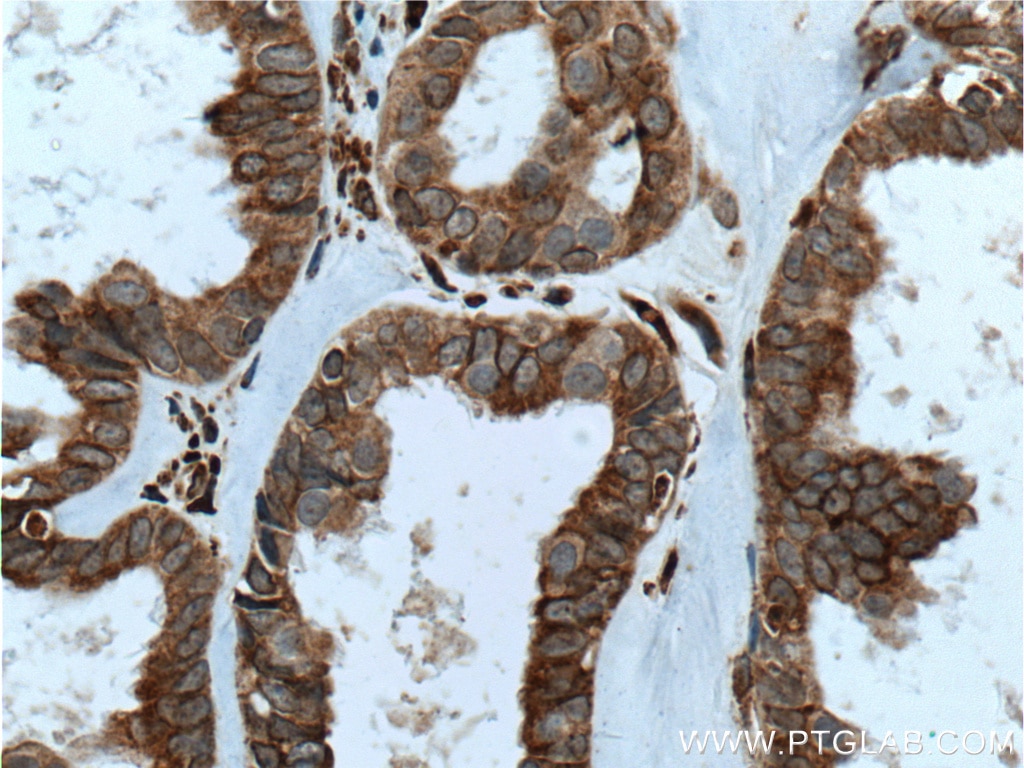 IHC staining of human ovary tumor using 14589-1-AP