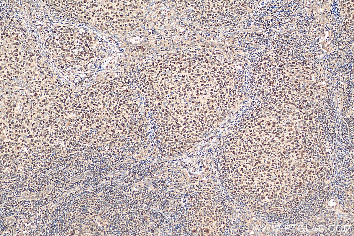 Immunohistochemistry (IHC) staining of human lymphoma tissue using IKZF1 Polyclonal antibody (12016-1-AP)