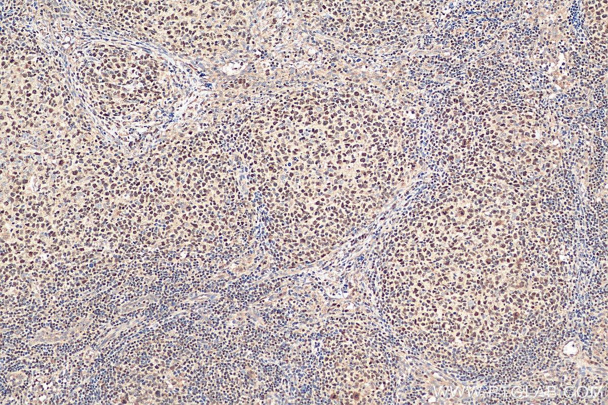 IHC staining of human lymphoma using 12016-1-AP