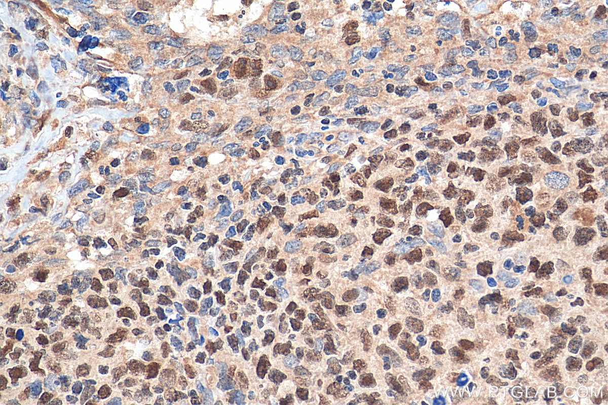 Immunohistochemistry (IHC) staining of human lymphoma tissue using IKZF1 Polyclonal antibody (12016-1-AP)