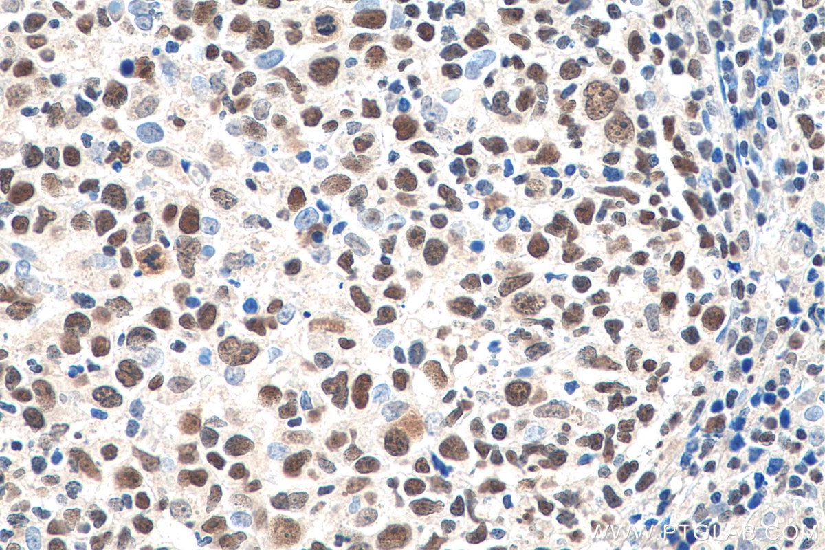Immunohistochemistry (IHC) staining of human lymphoma tissue using IKZF1 Monoclonal antibody (66966-1-Ig)