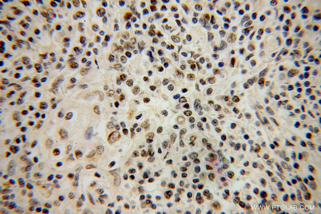 Immunohistochemistry (IHC) staining of human lymphoma tissue using HELIOS Polyclonal antibody (13554-1-AP)