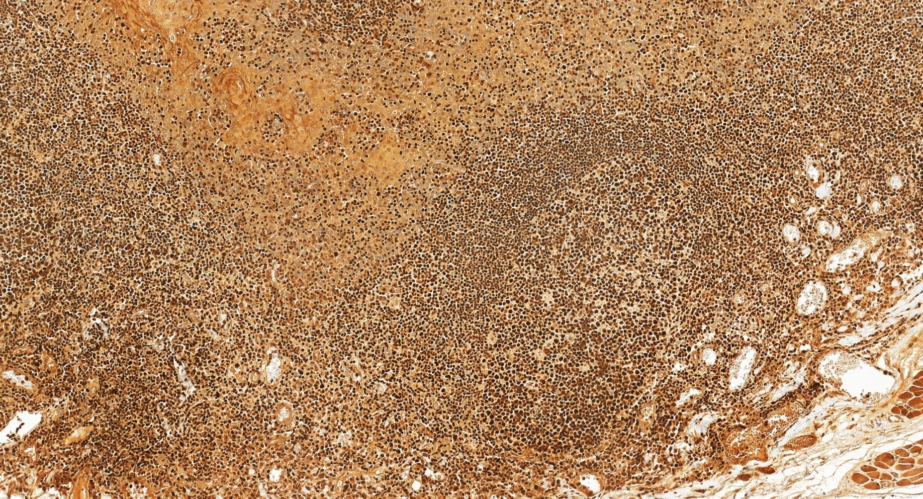 Immunohistochemical analysis of paraffin-embedded human tonsillitis tissue slide using 19055-1-AP (Aiolos/IKZF3 antibody) at dilution of 1:200 (under 20x lens). Heat mediated antigen retrieval with Tris-EDTA buffer (pH 9.0). Immunohistochemistry (IHC) staining of human tonsillitis tissue using Aiolos/IKZF3 Polyclonal antibody (19055-1-AP)