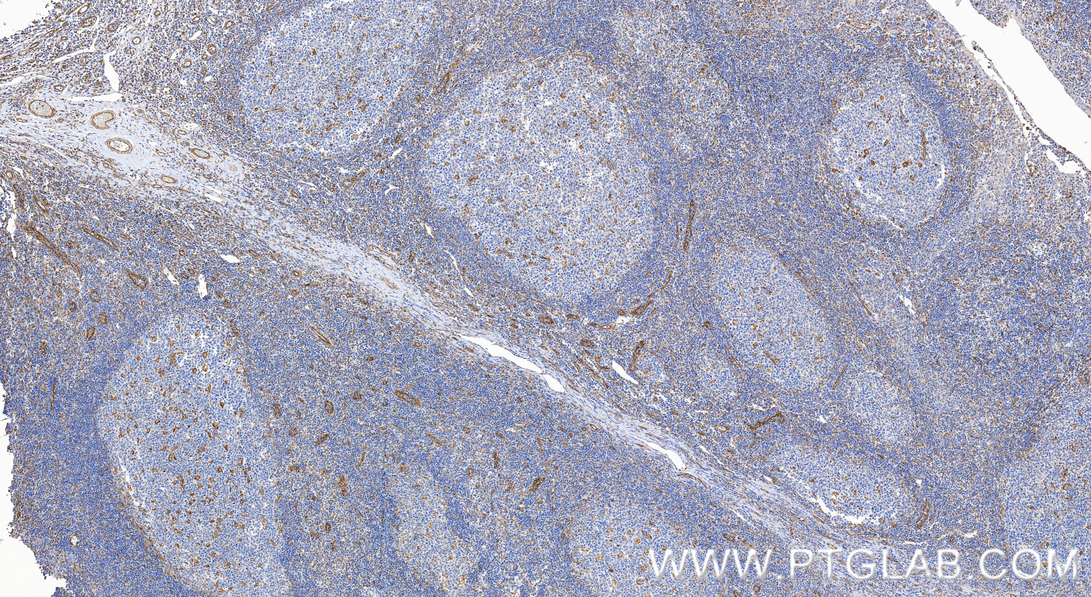Immunohistochemistry (IHC) staining of human tonsillitis tissue using IL-15 Recombinant monoclonal antibody (84512-4-RR)