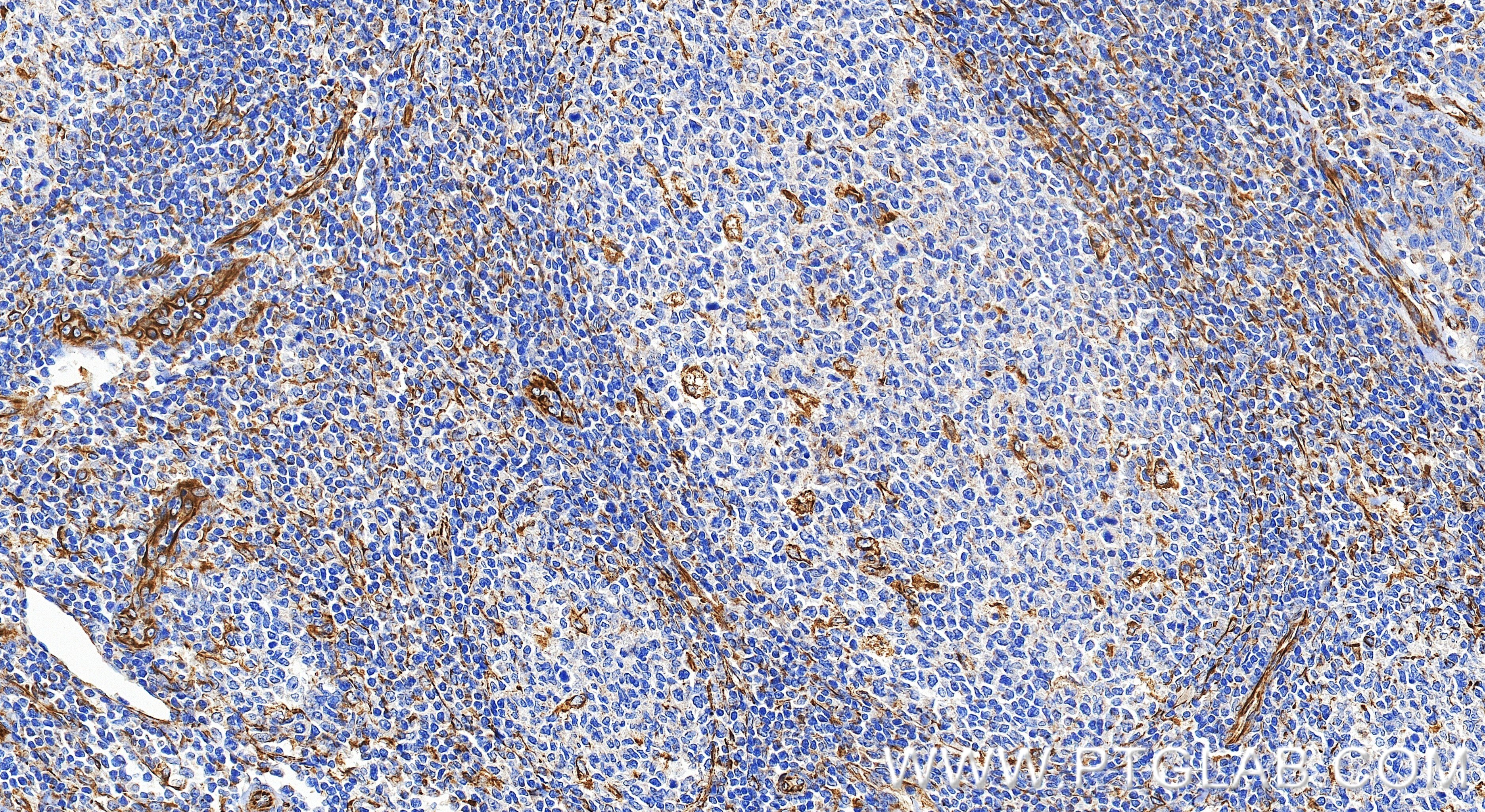 Immunohistochemistry (IHC) staining of human tonsillitis tissue using IL-15 Recombinant monoclonal antibody (84512-4-RR)