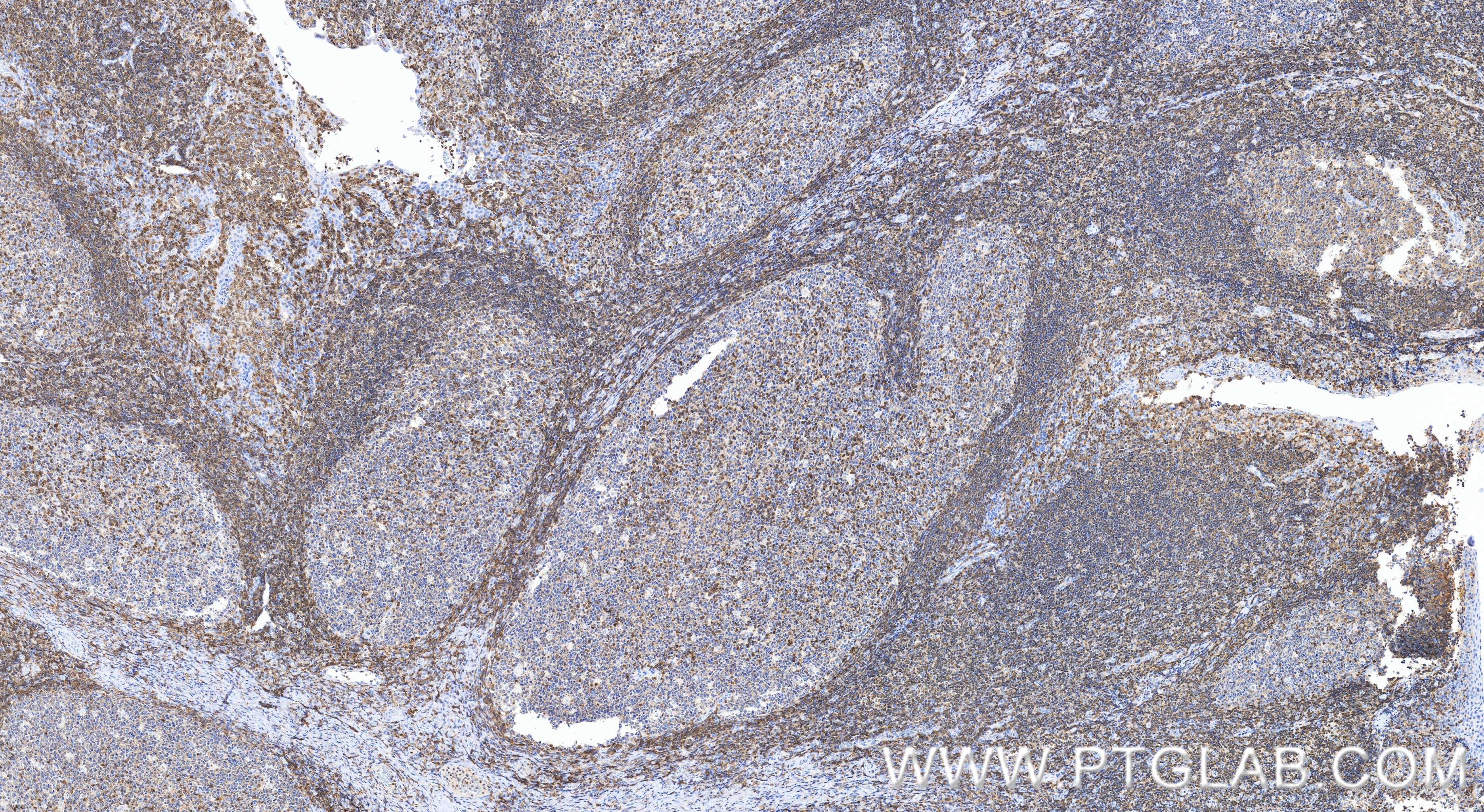 IHC staining of human tonsillitis using 86927-2-RR (same clone as 86927-2-PBS) Immunohistochemistry (IHC) staining of human tonsillitis tissue using IL-16 Recombinant monoclonal antibody (86927-2-RR)