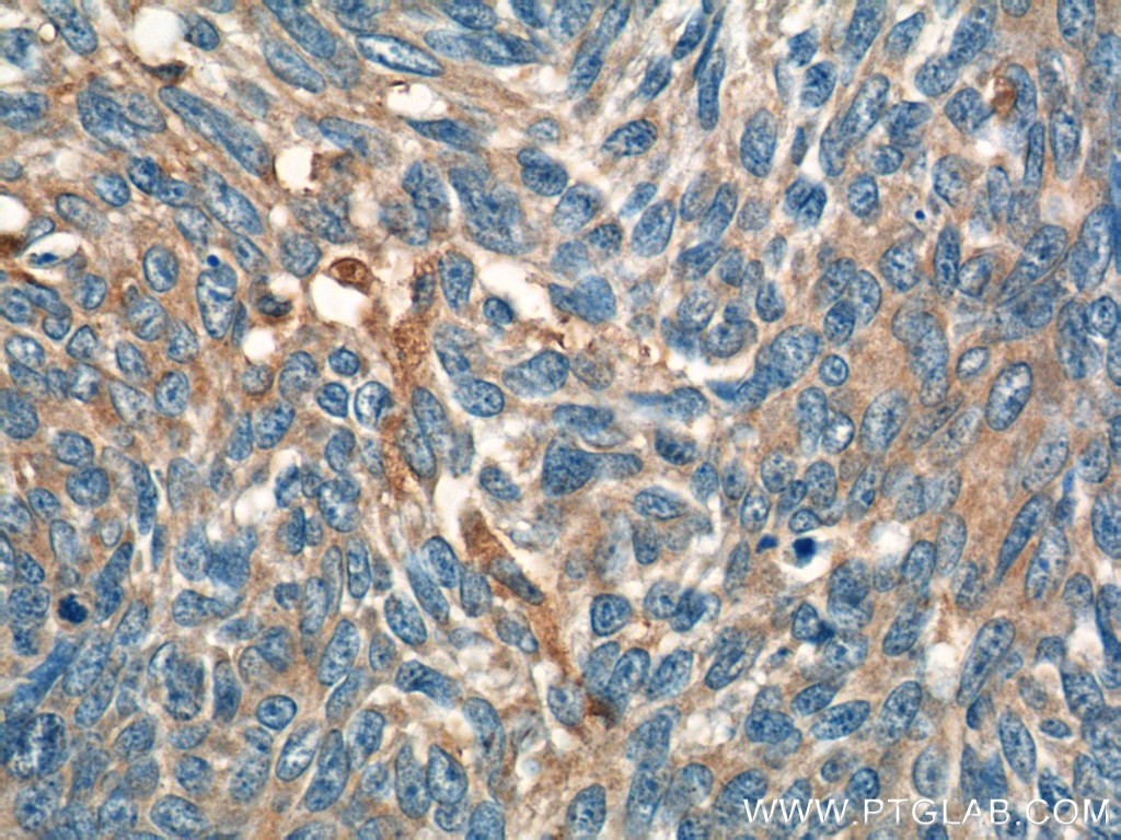 Immunohistochemistry (IHC) staining of human skin cancer tissue using IL-19 Polyclonal antibody (23705-1-AP)