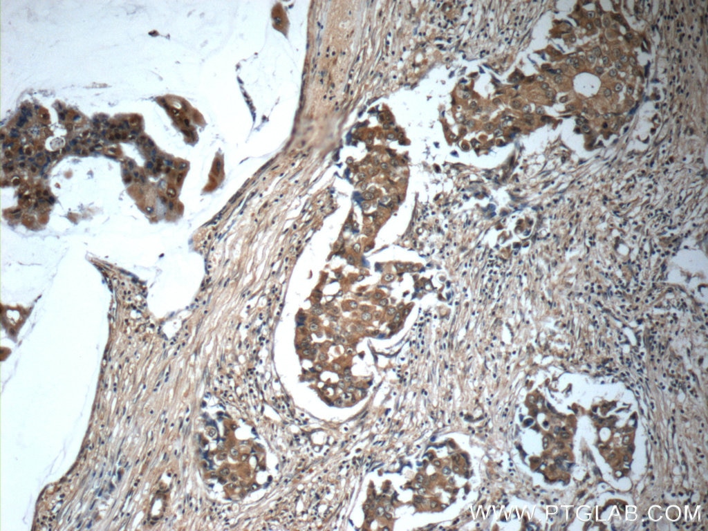 Immunohistochemistry (IHC) staining of human breast cancer tissue using IL-19 Polyclonal antibody (24402-1-AP)